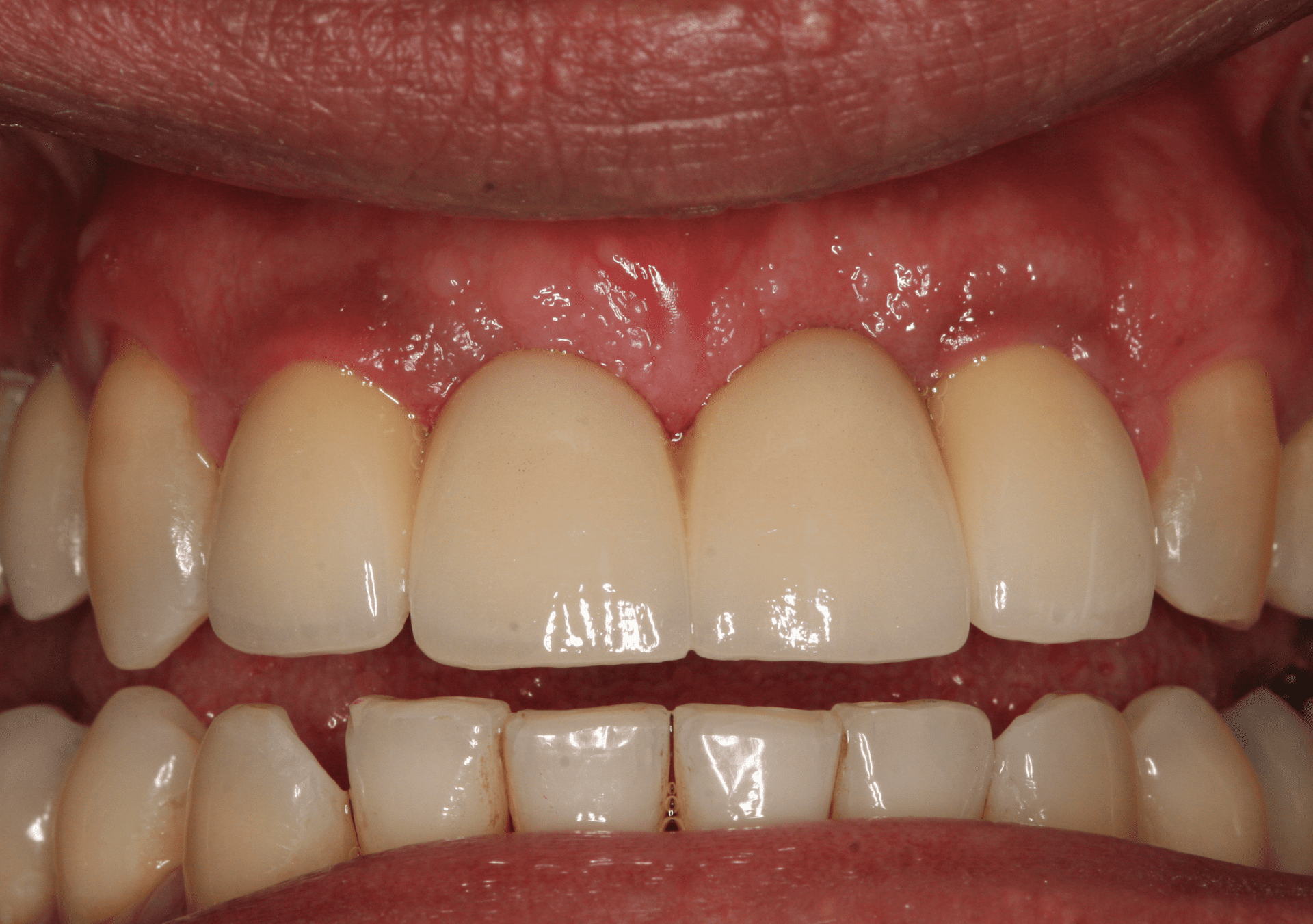 Dental Implants Case 2