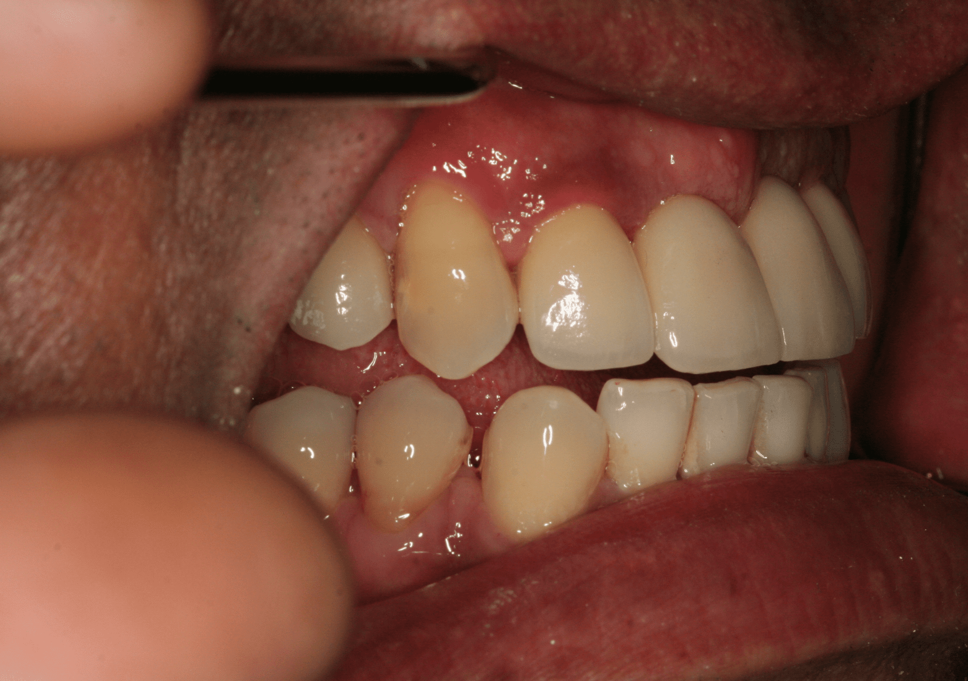 Dental Implants Case 2