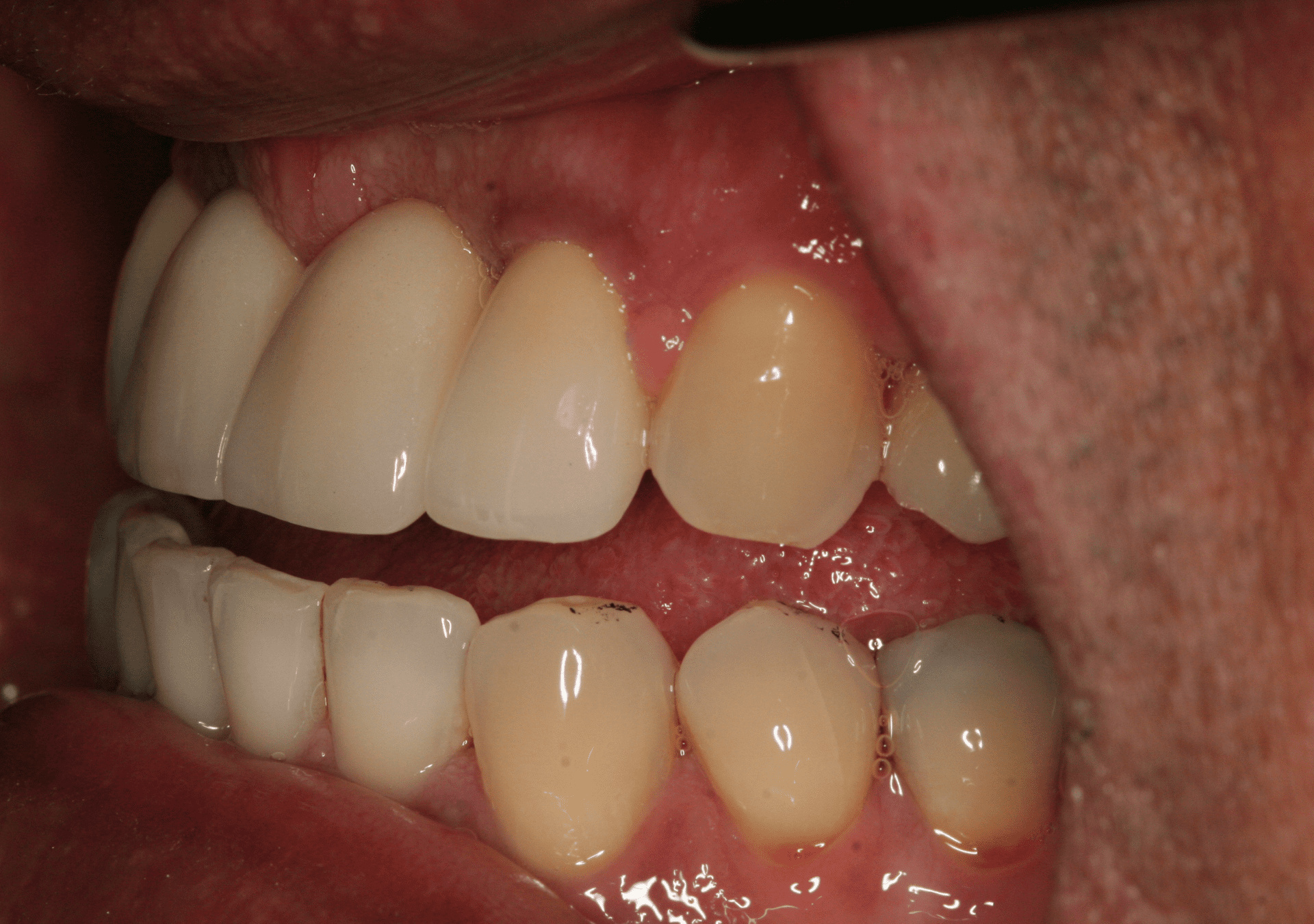 Dental Implants Case 2