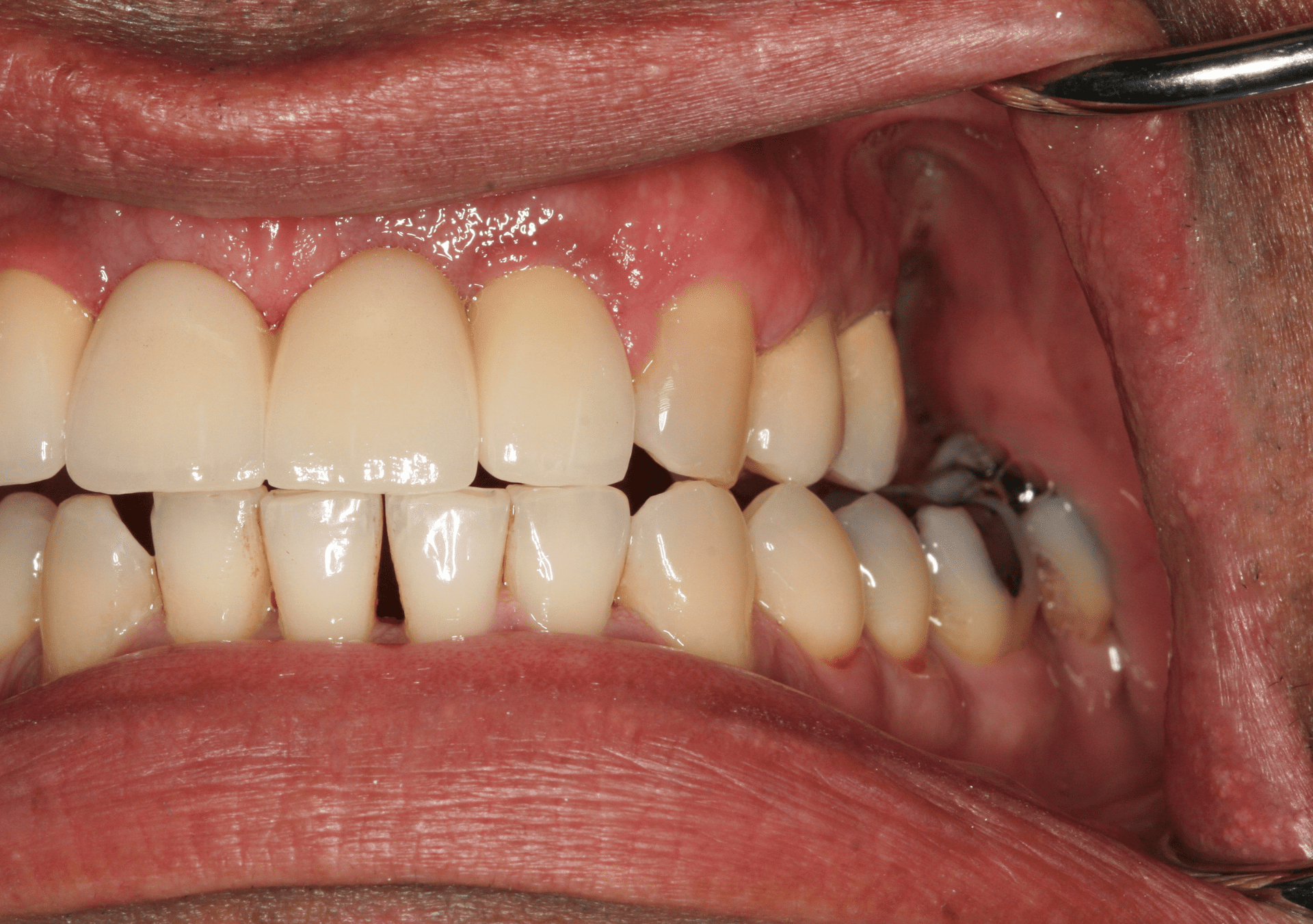 Dental Implants Case 2