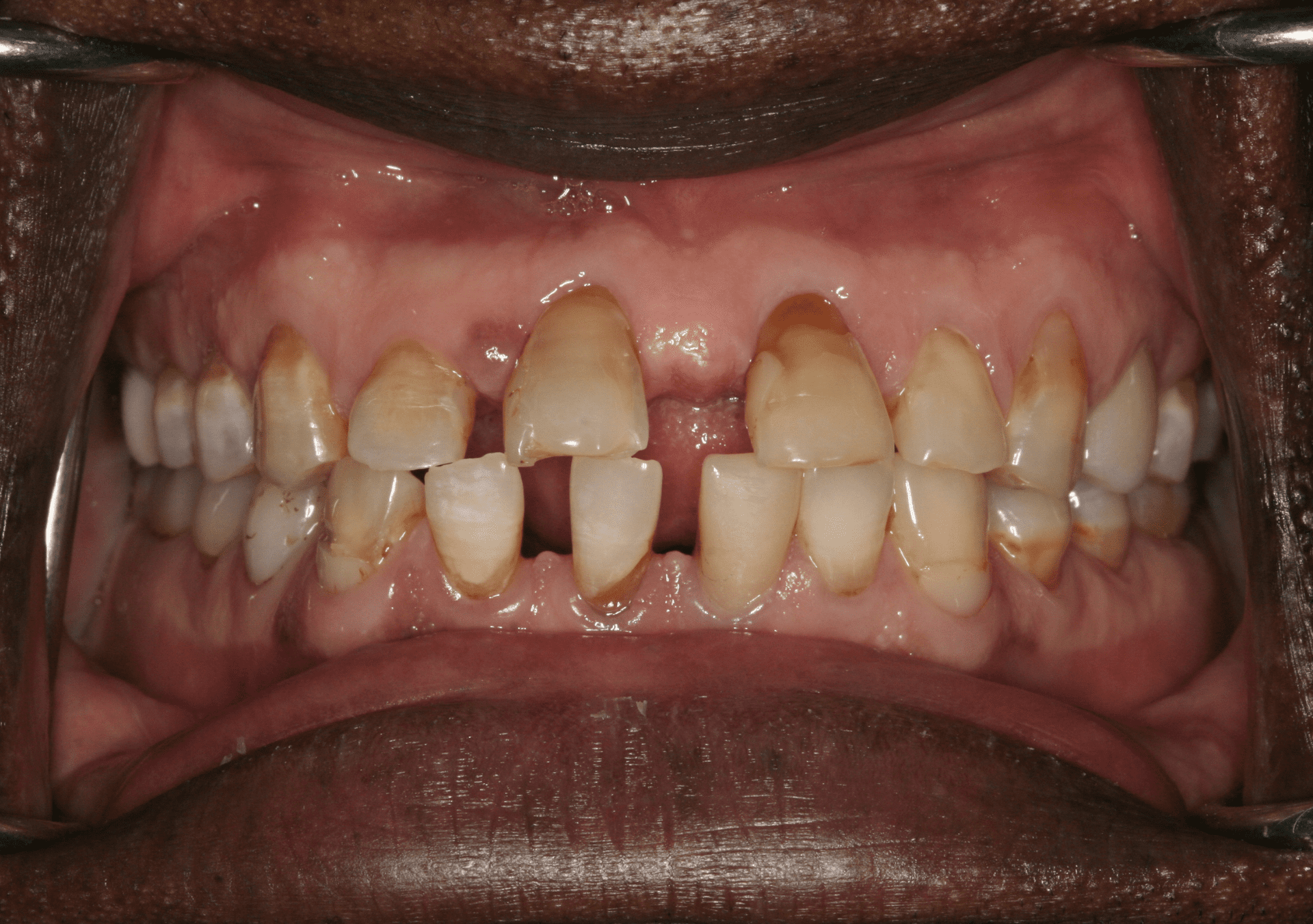 Oral Rehabilitation Case 1