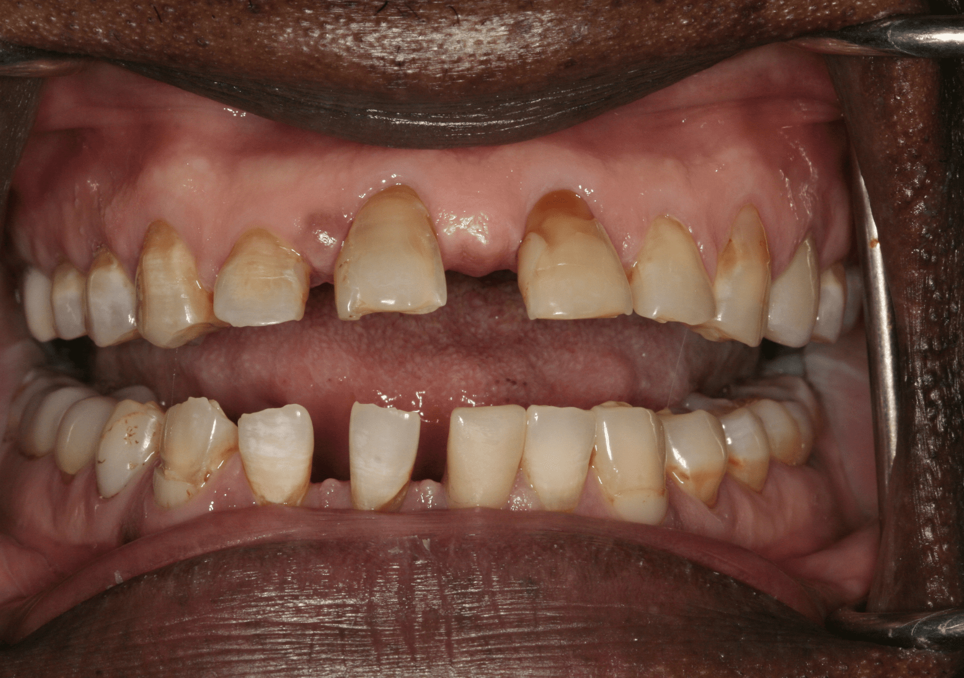 Oral Rehabilitation Case 1