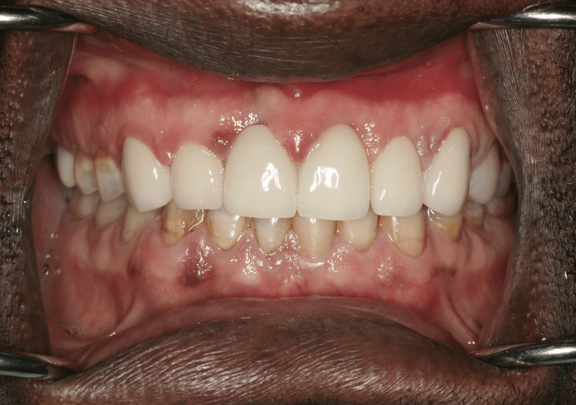 Oral Rehabilitation Case 1