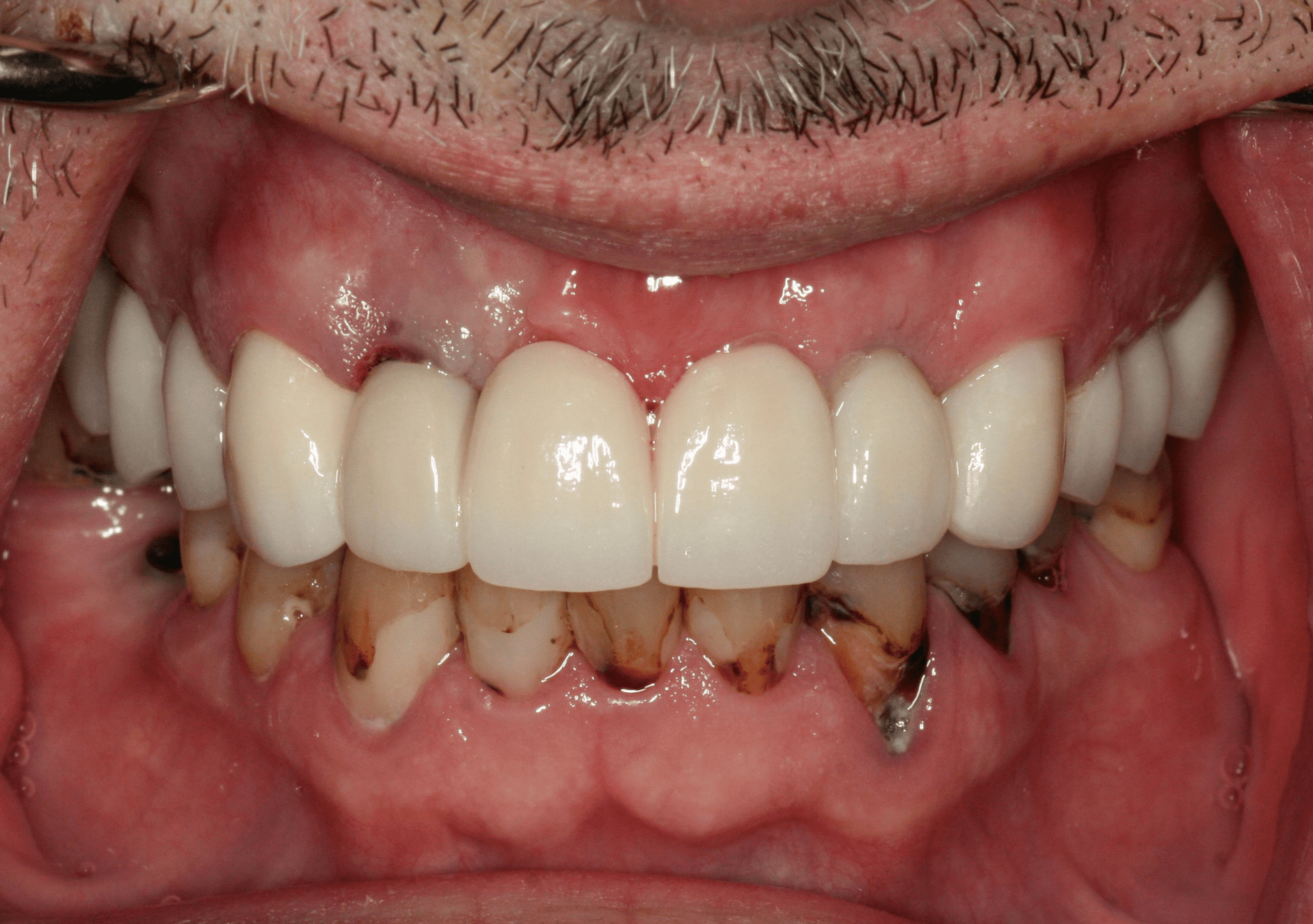 Oral Rehabilitation Case 2