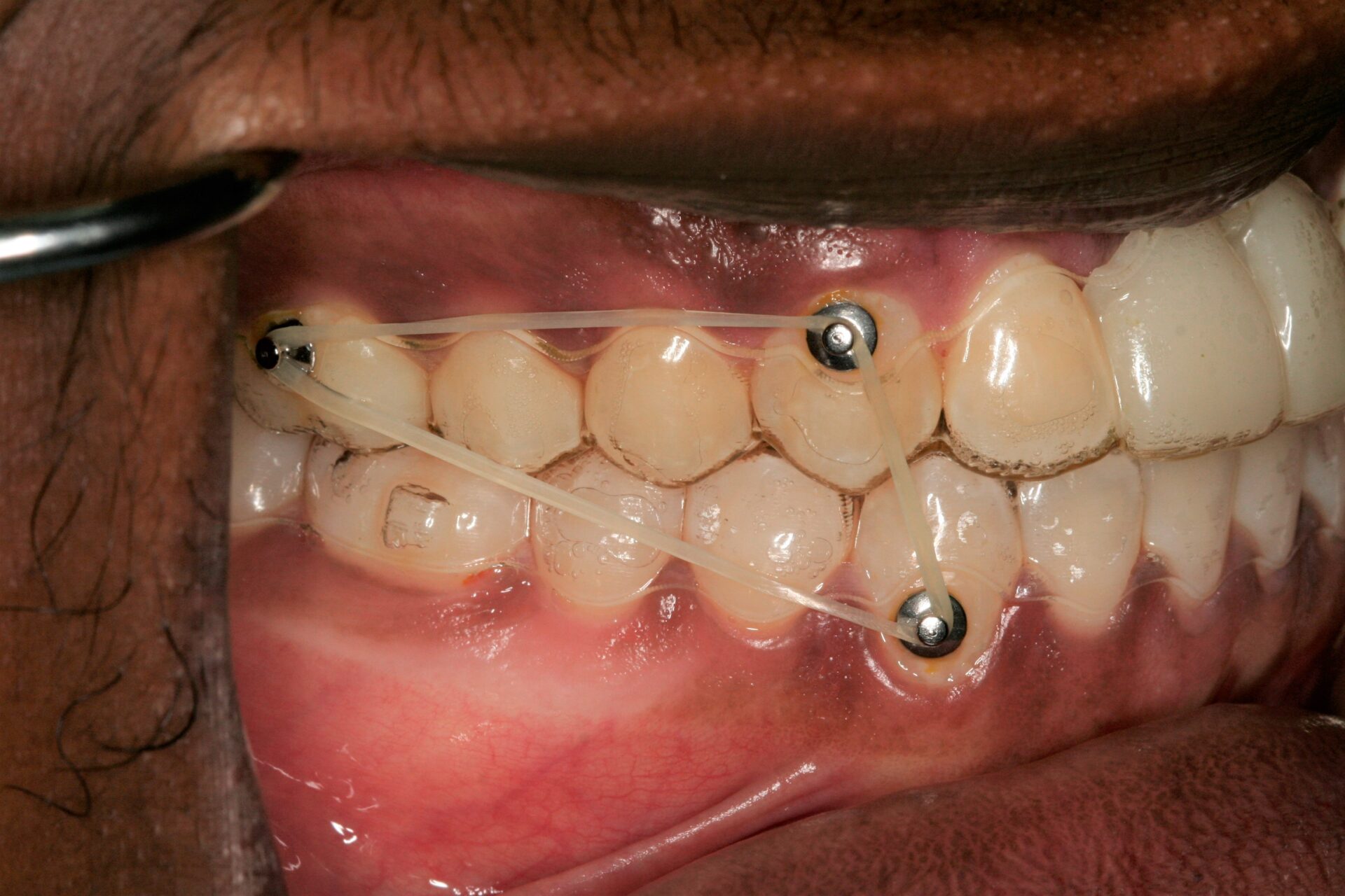 Dental Implants Case 3