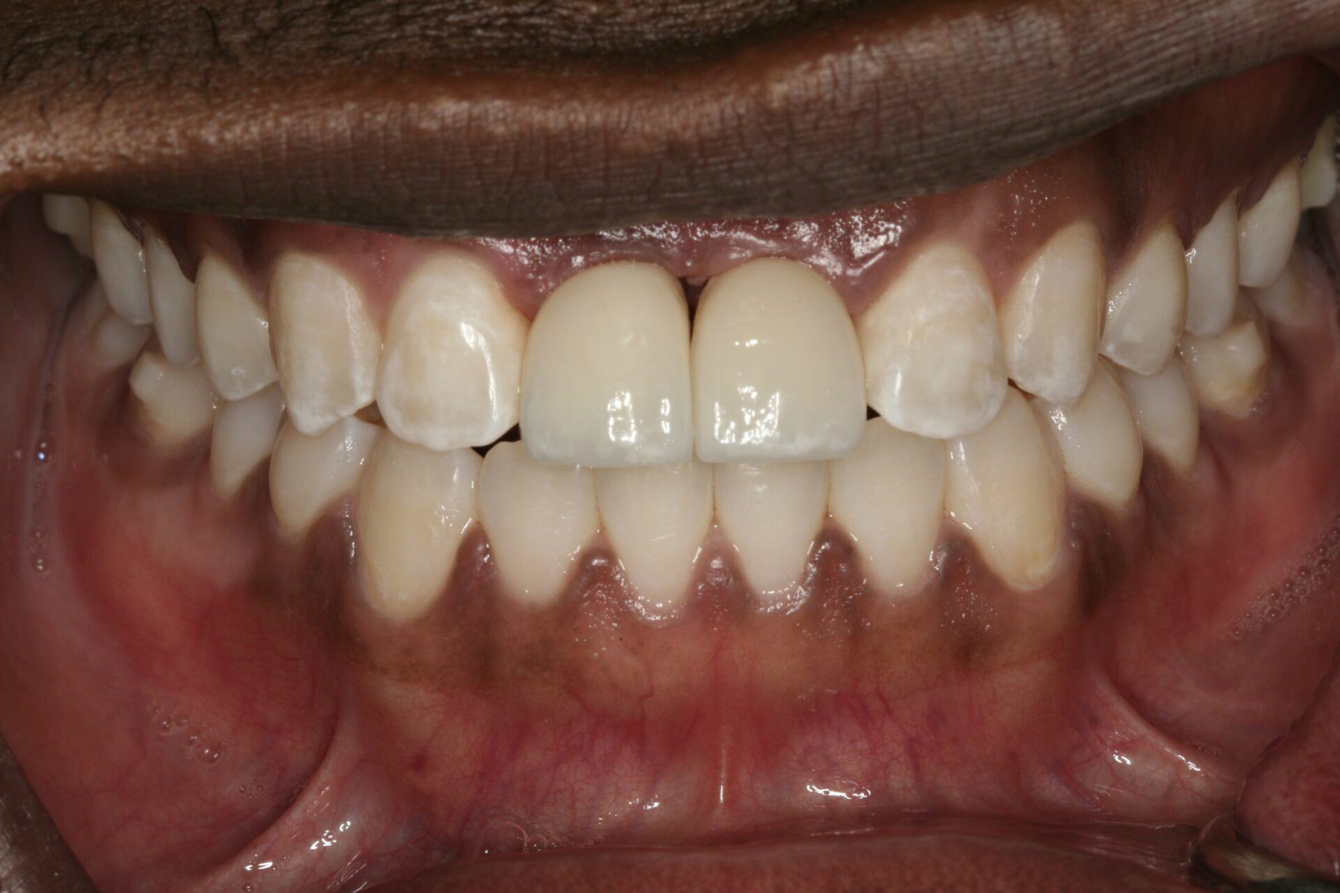 Dental Implants Case 3