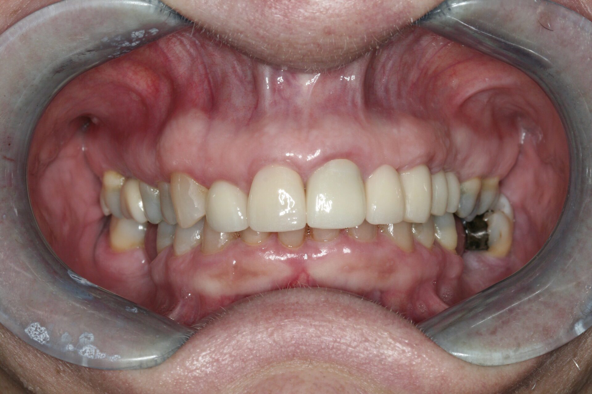 Oral Rehabilitation Case 3