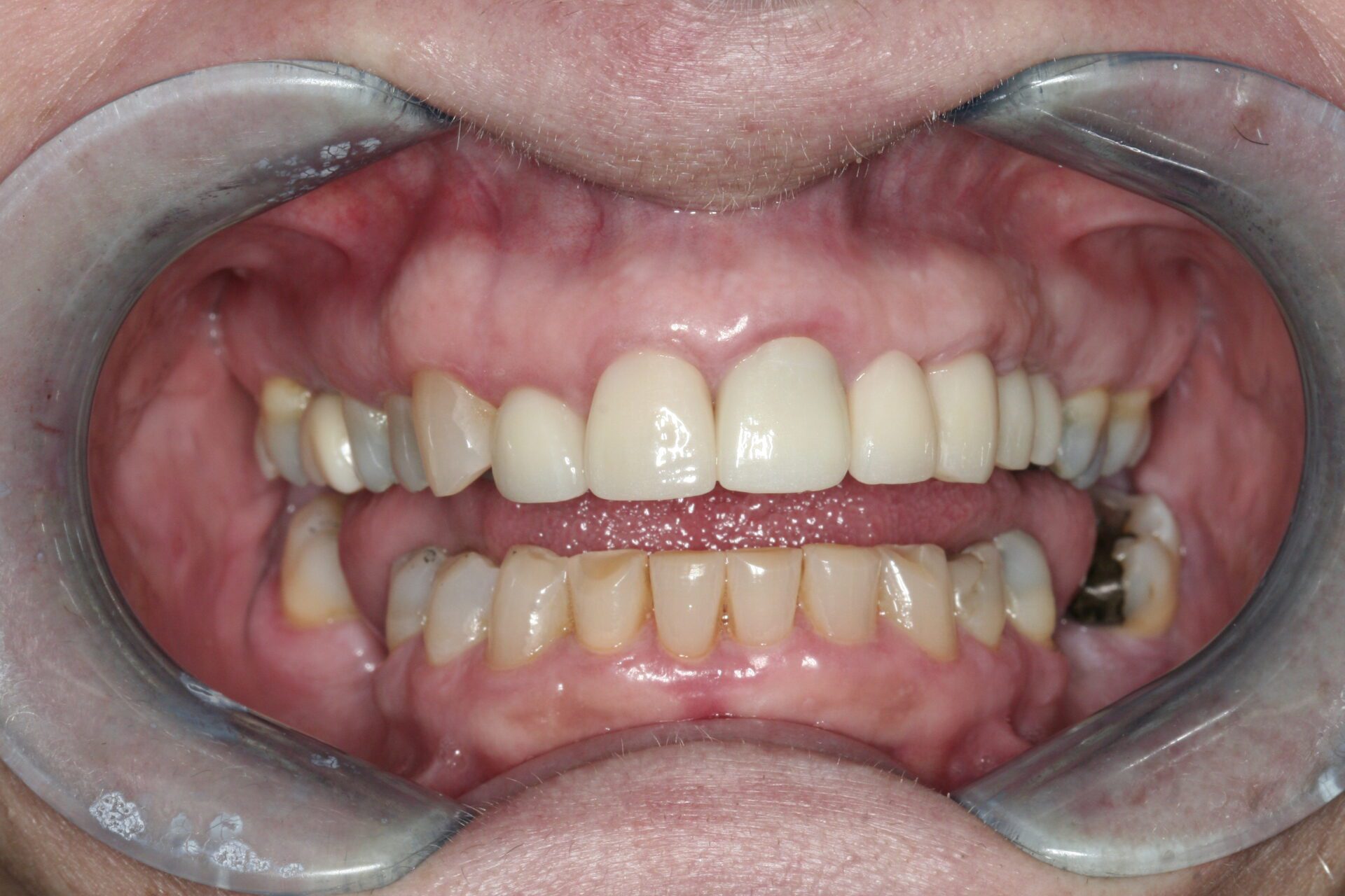 Oral Rehabilitation Case 3