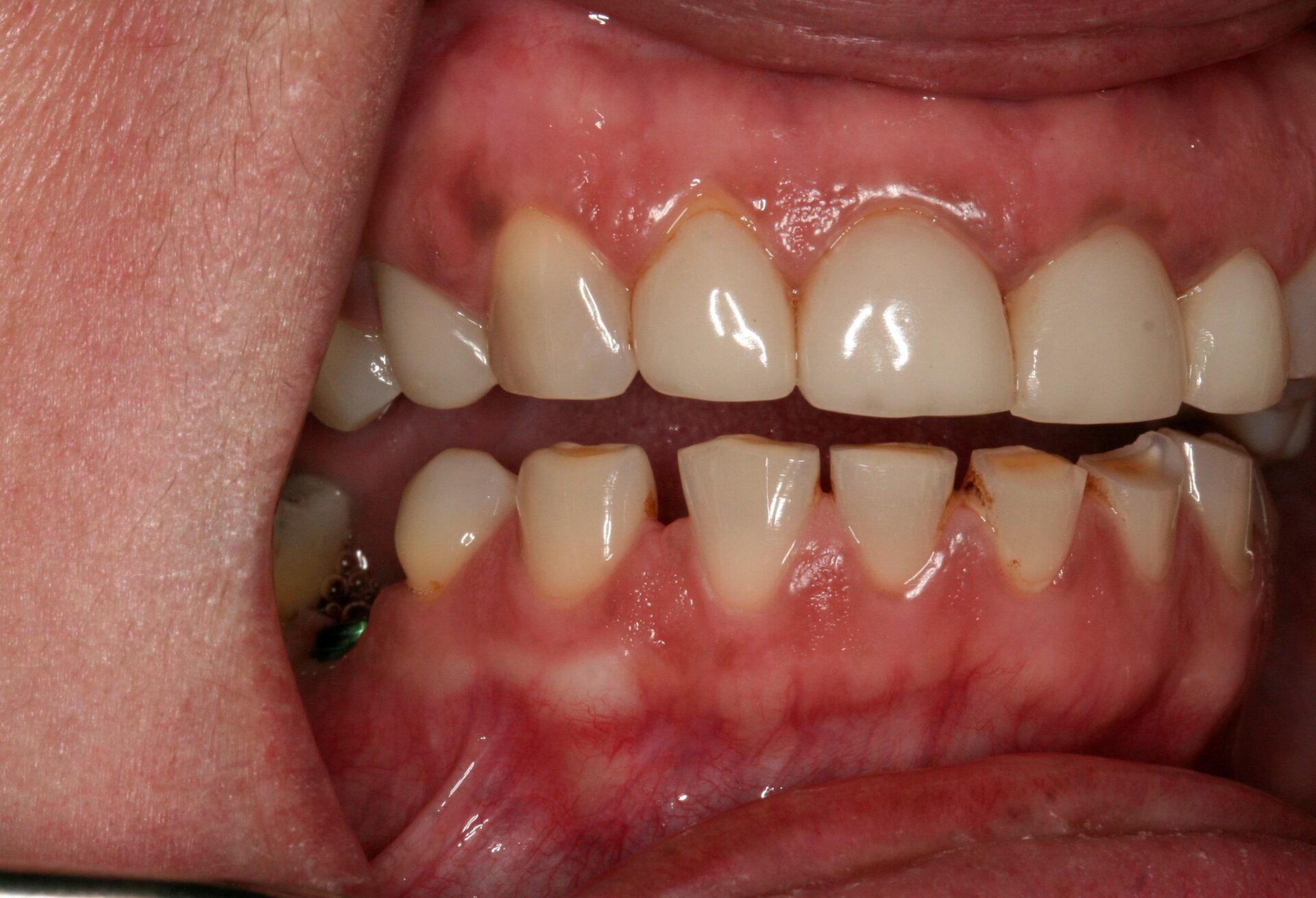 Oral Rehabilitation Case 3