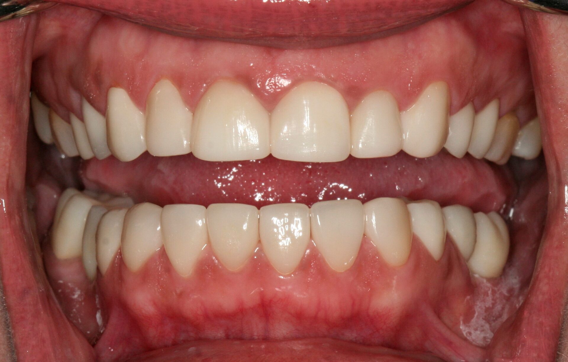 Oral Rehabilitation Case 3